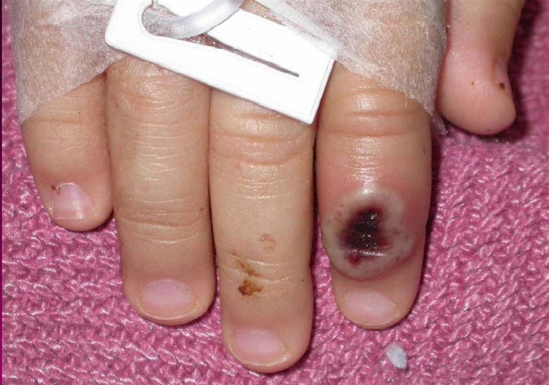 Fotografía de archivo del Centro Estadounidense de Control de las Enfermedades (CDC) en la que se aprecia el dedo de un niño infectado por la llamada 