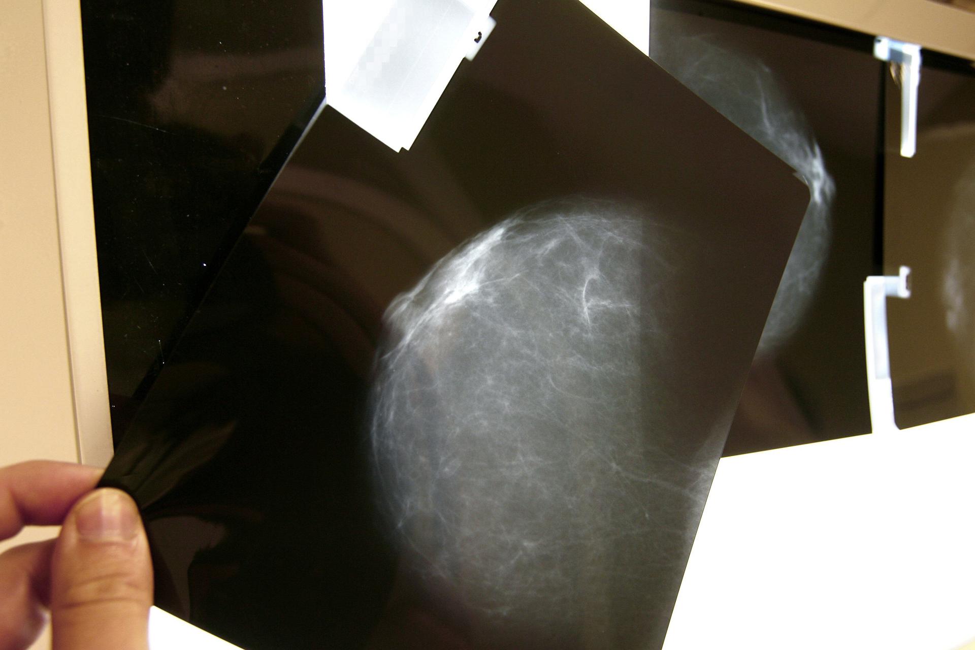 Fotografía de archivo de una prueba radiológica de mama. EFE/Archivo/Chema Moya
