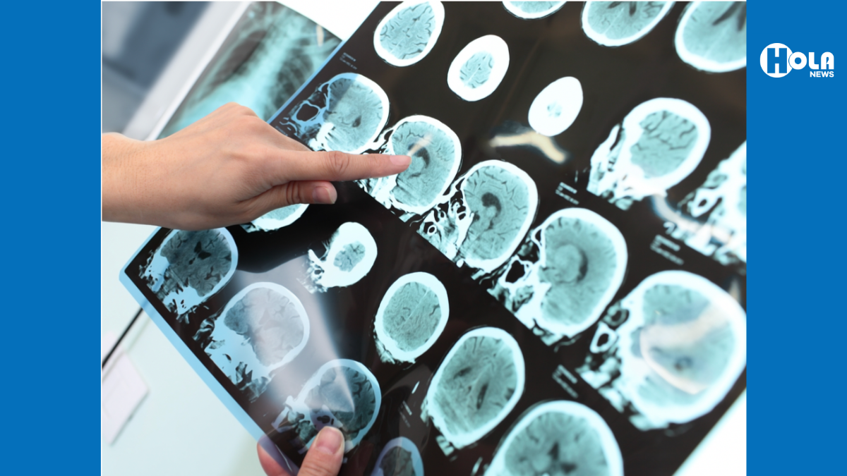 Universidades realizan ensayos clínicos de medicamento para prevenir el Alzheimer