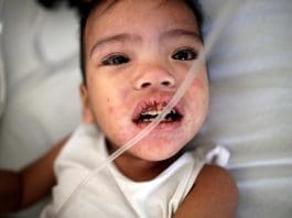 Florida alerta de brotes de sarampión en universidades ante récord del virus en EEUU Imagen de archivo de un niño enfermo de sarampión. EFE/ Francis R. Malasig