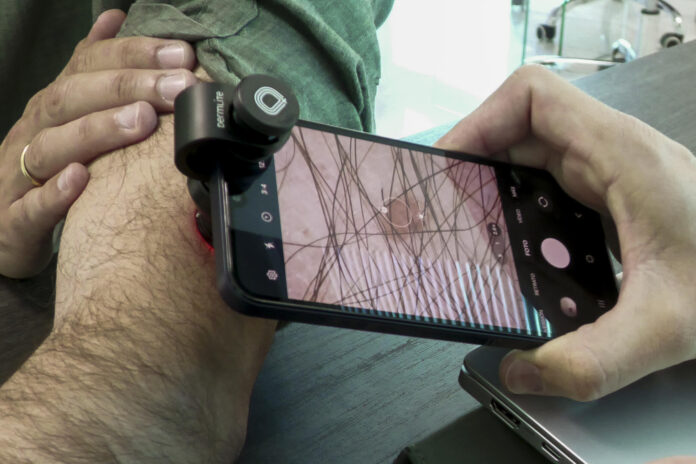 México registra 2.198 casos anuales de melanoma cutáneo, lo que lo convierte en el segundo país de Latinoamérica con mayor incidencia de esta enfermedad, mientras ocho de cada 10 pacientes reciben el diagnóstico en etapas avanzadas, advirtieron especialistas. Imagen de archivo. EFE/David Arjona
