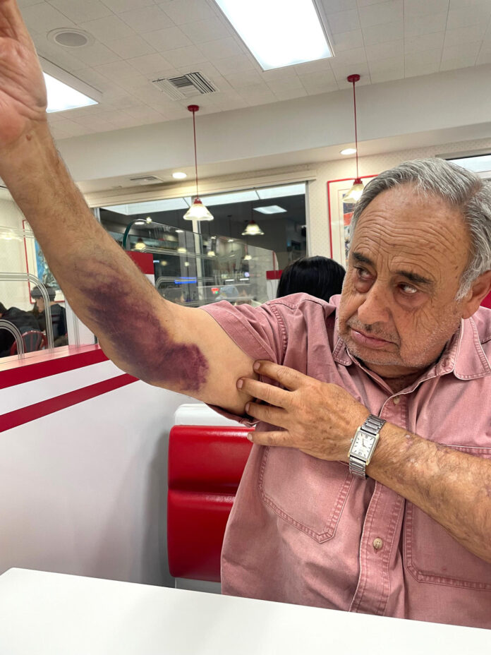Fotografía cedida por el bufete de abogados V. James DeSimone Law de Rafie Shouhed quien demandó este jueves por 50 millones de dólares al Gobierno del presidente Donald Trump, tras sufrir graves lesiones durante una redada de inmigración realizada en septiembre pasado en su negocio en Los Ángeles (EE.UU.). EFE/ V. James DeSimone Law /SOLO USO EDITORIAL /NO VENTAS /SOLO DISPONIBLE PARA ILUSTRAR LA NOTICIA QUE ACOMPAÑA /CRÉDITO OBLIGATORIO
